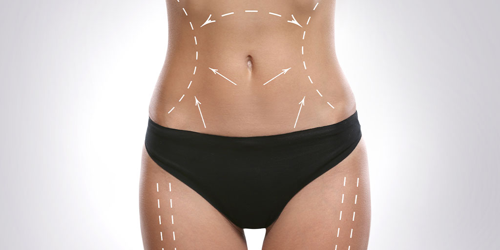 A woman in black underwear with white dashed lines and arrows drawn on her stomach, indicating areas on the abdomen and thighs.